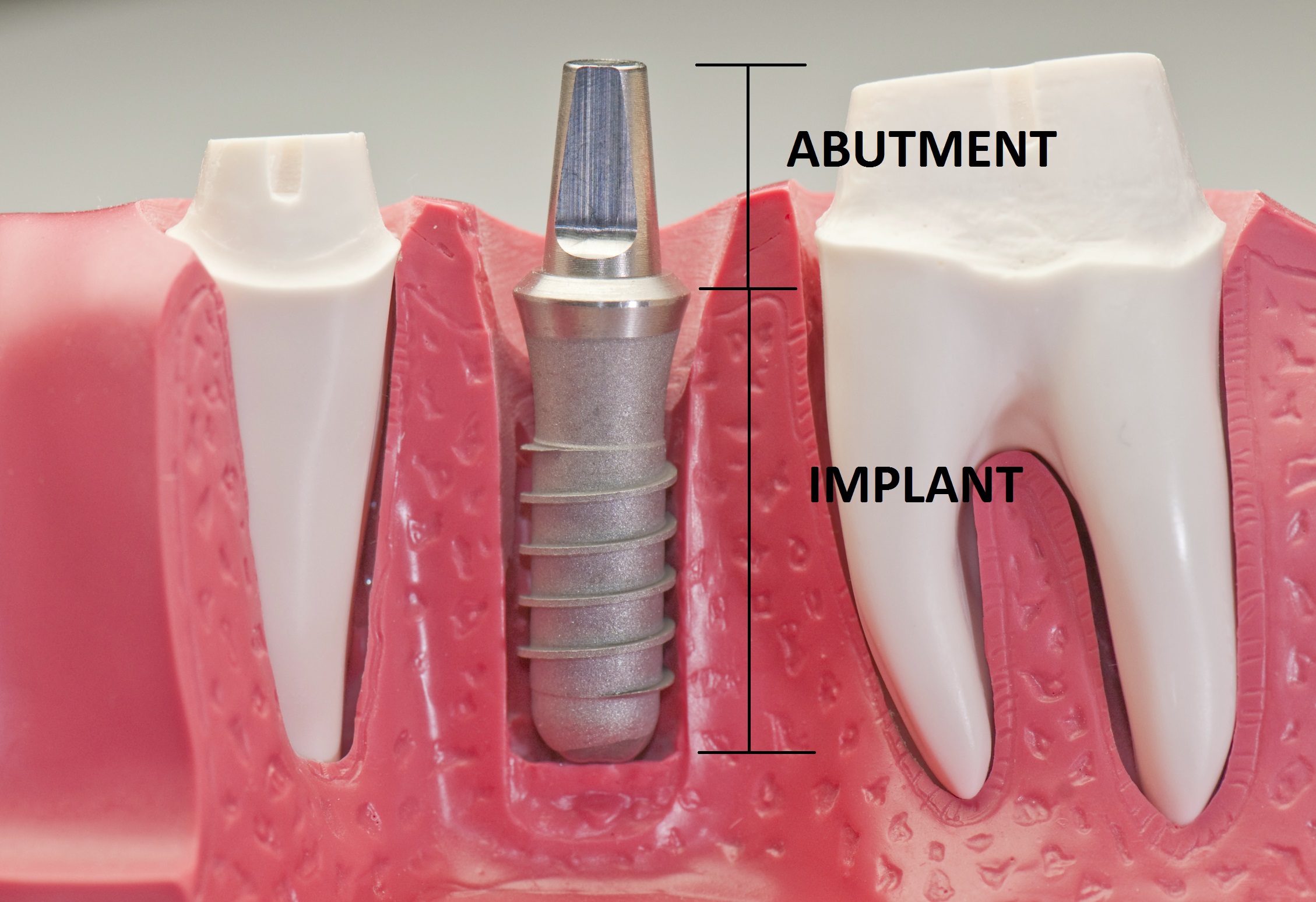 Abutment tùy chỉnh