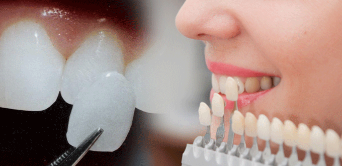 Mặt dán sứ Veneer