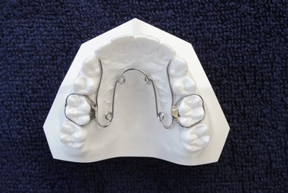 Hàm nắn QuardHelix