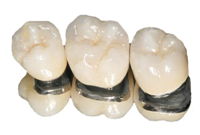 Răng sứ kim loại Cobalt
